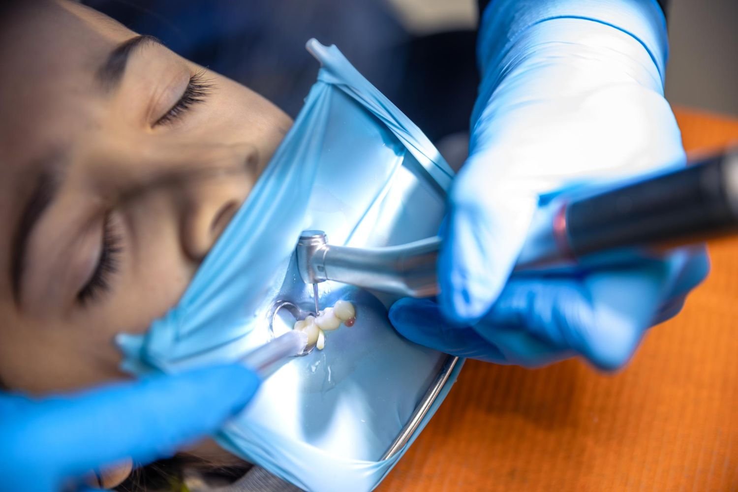 RCT – Root Canal Treatment
